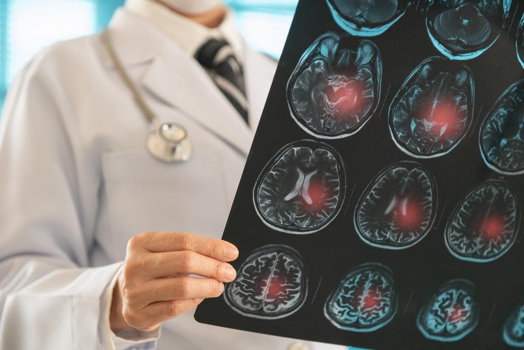 AVC : pourquoi les chercheurs s’intéressent-ils soudainement à l’acide urique ?
