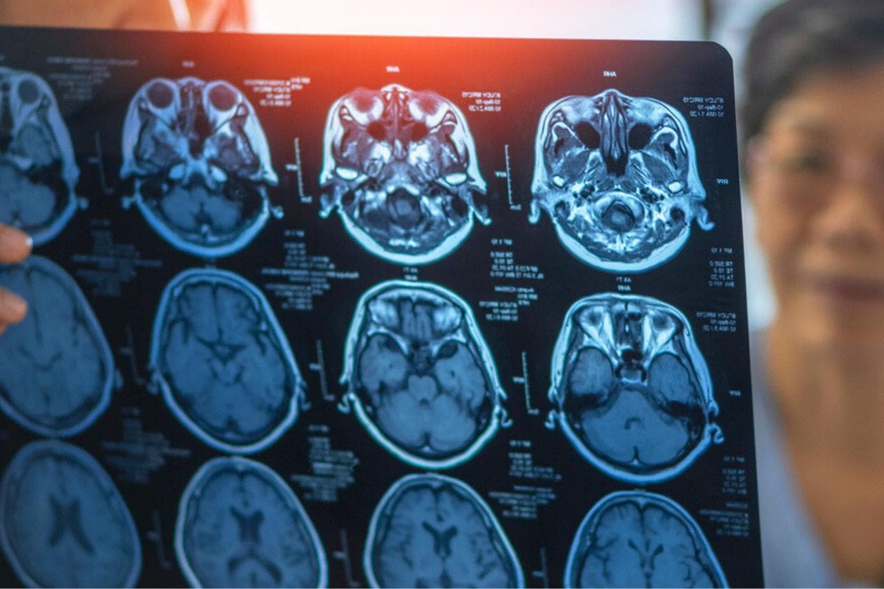 Alzheimer : ce coupable caché dans le cerveau intrigue de plus en plus les chercheurs