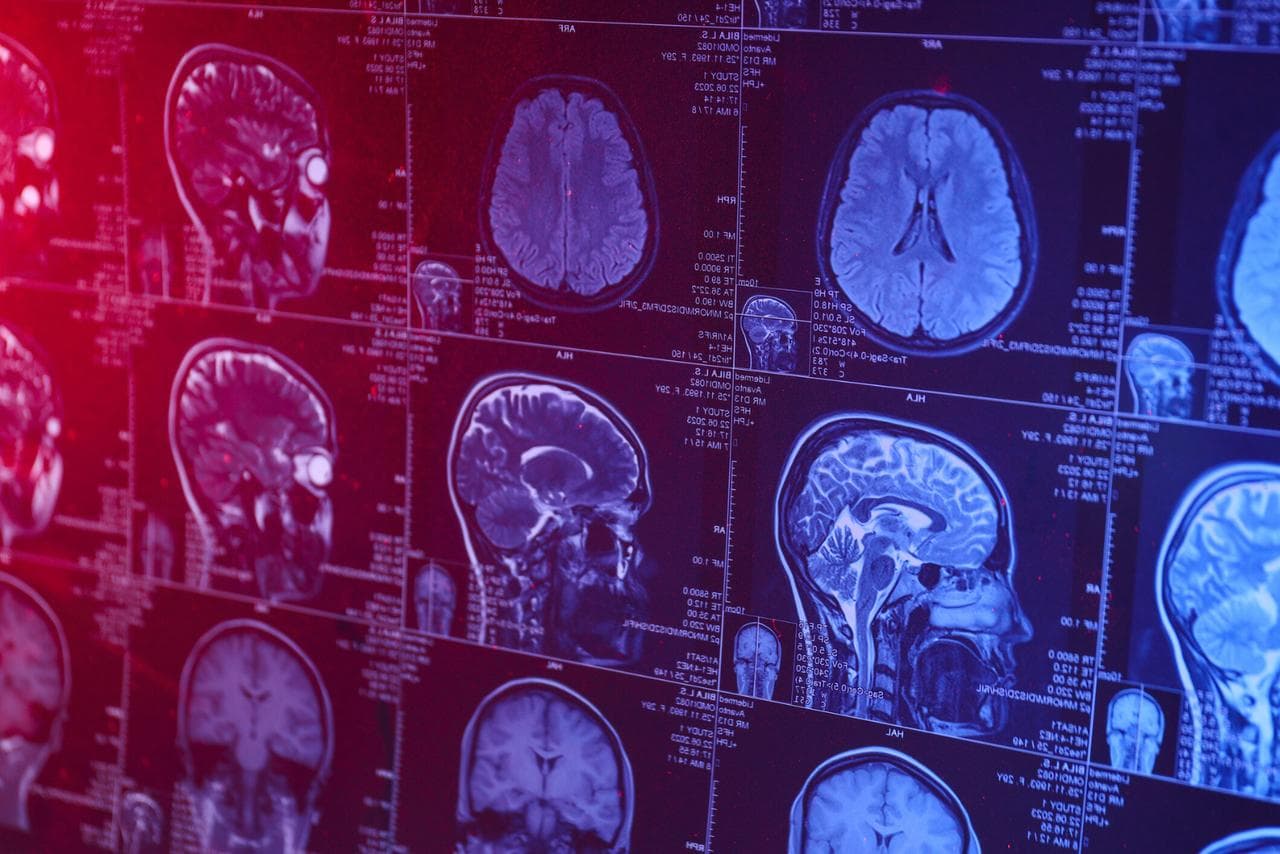 Alzheimer à 19 ans : le cas qui fait vaciller toutes les certitudes