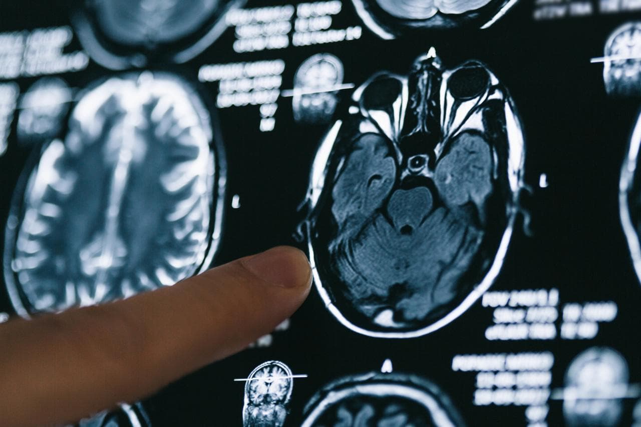 Voici le marqueur biologique qui pourrait réduire le risque de démence et d'Alzheimer selon une vaste étude