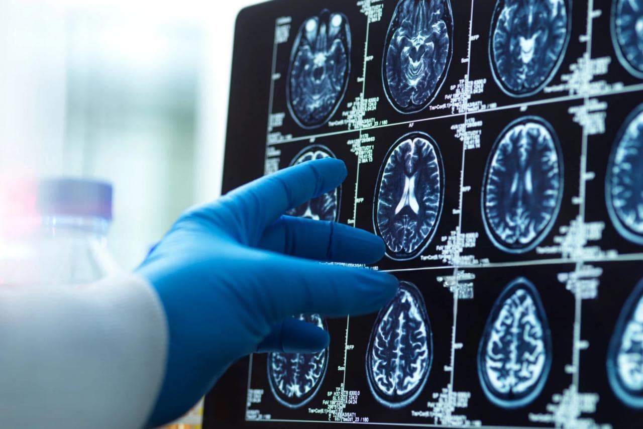 Cette substance vient d'être détectée en grande quantité dans des cerveaux humains et les chercheurs s'alarment