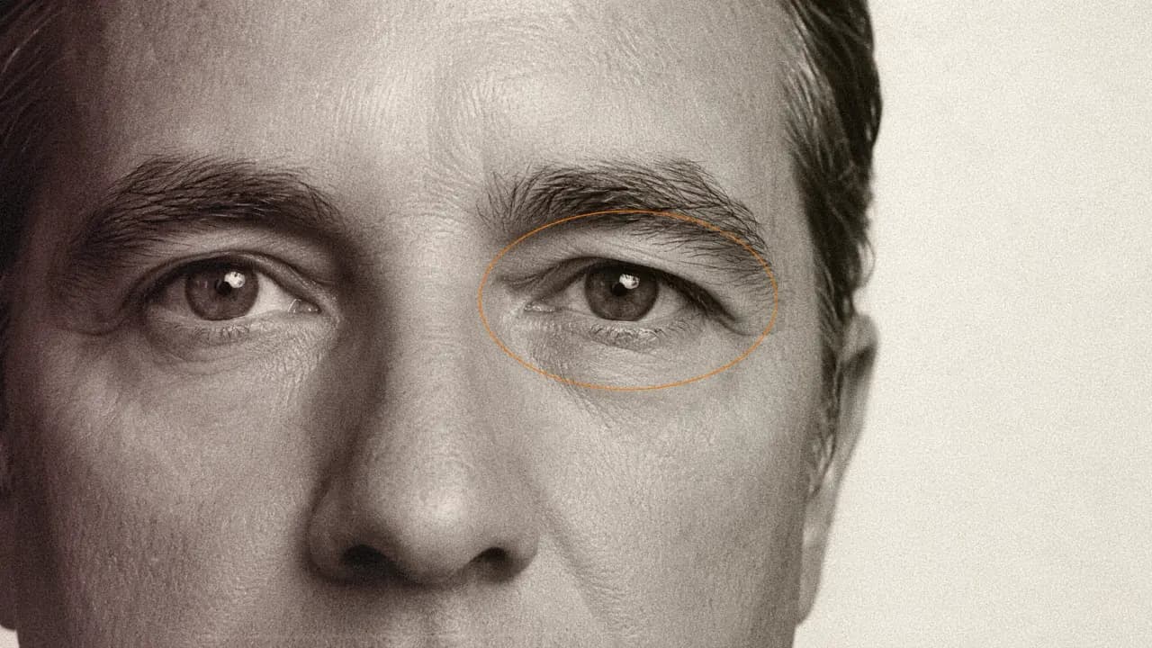 Infarctus et AVC : ces marques autour des yeux pourraient alerter sur un risque accru, selon une étude