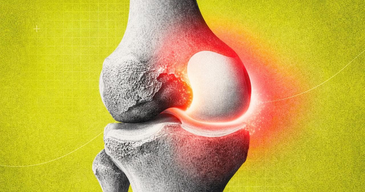 Arthrose : une piste testée pourrait enfin aider le cartilage à se réparer… et ça marche !