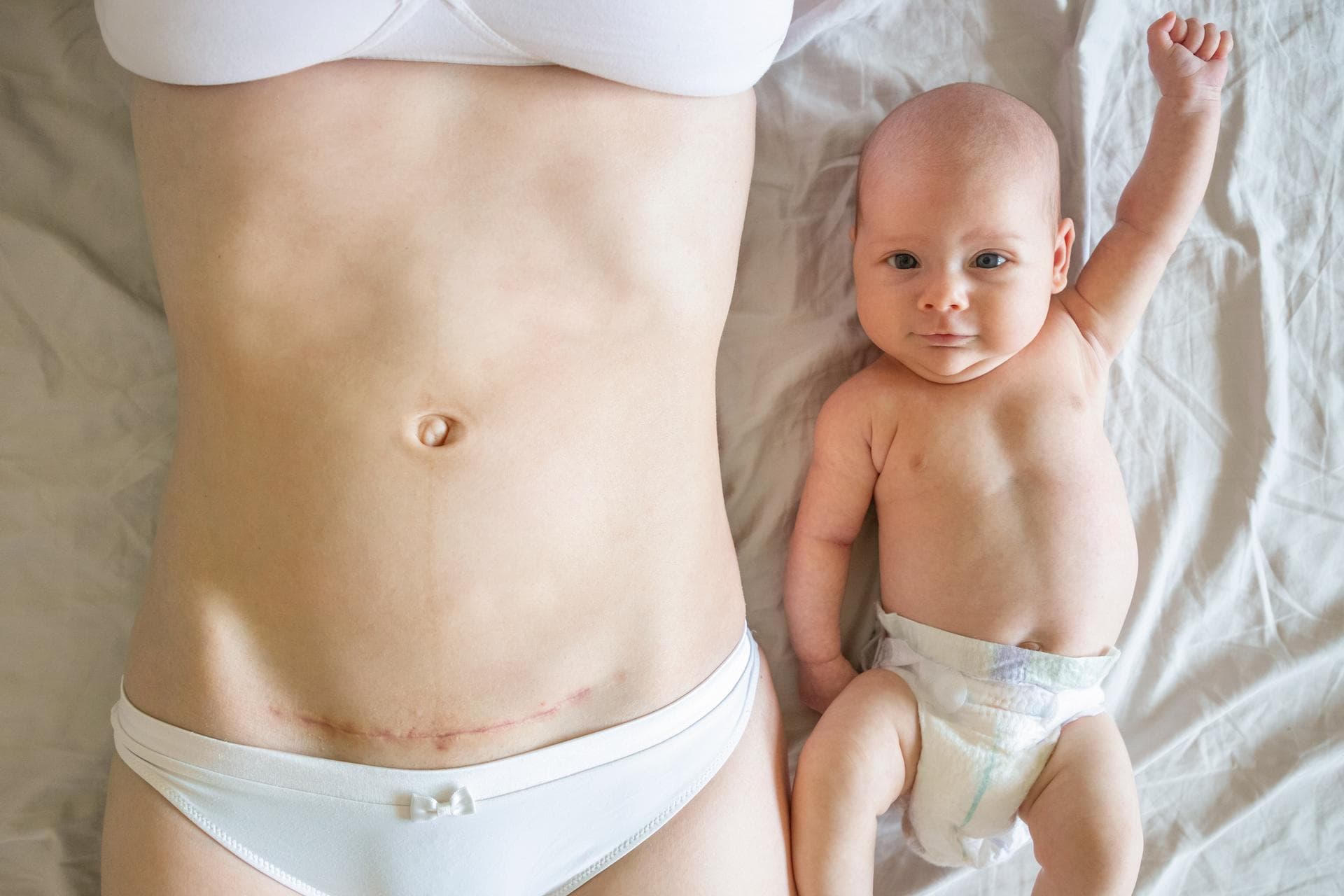 Césarienne : comment le sexe du bébé influence ses risques de maladies à long terme
