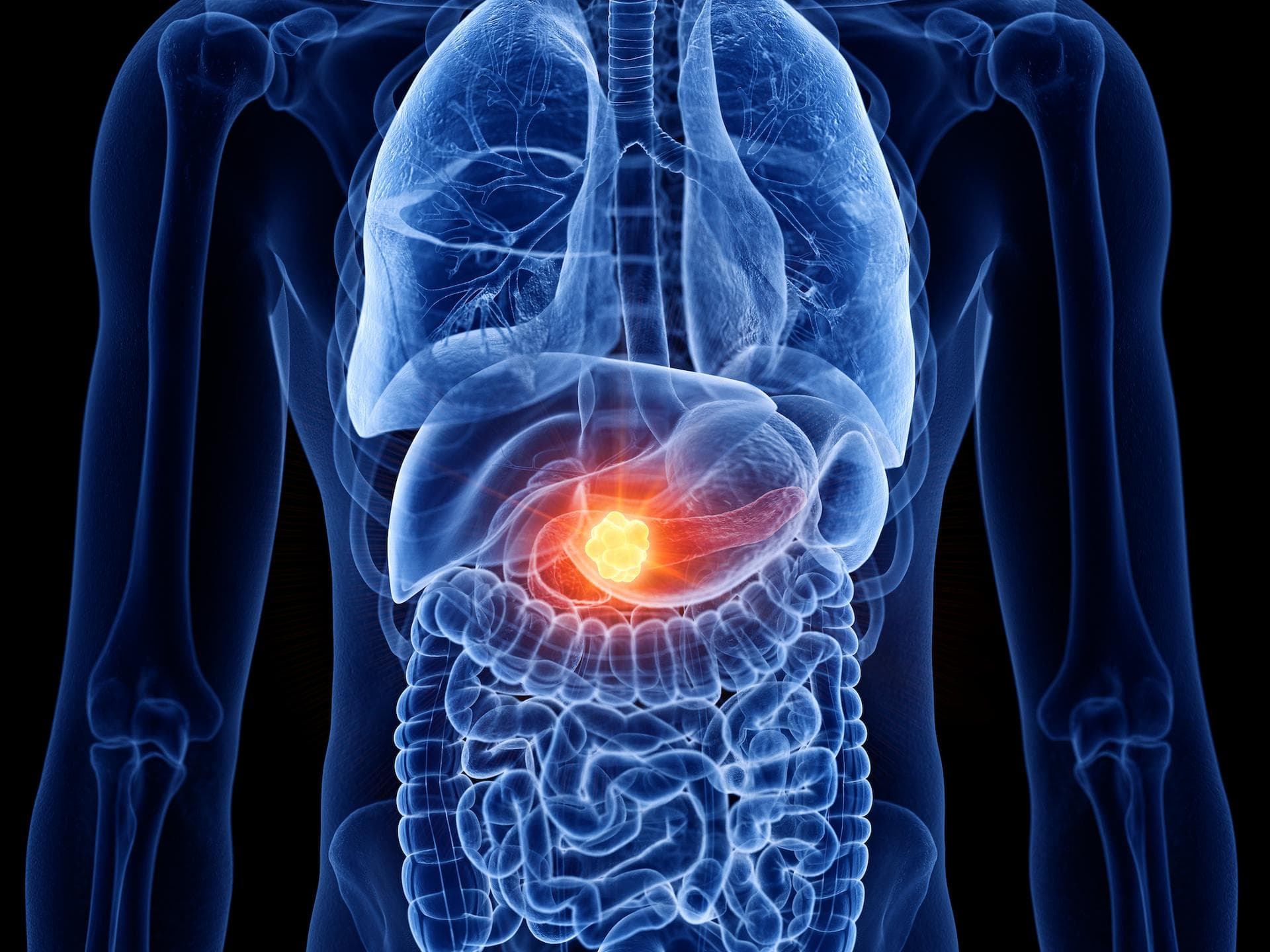 Espoir majeur dans le cancer du pancréas : un nouveau traitement double la survie des patients à un an